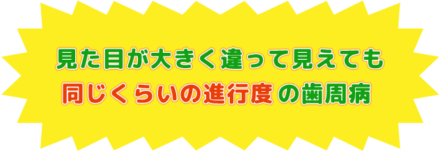 見た目が大きく違って見えても同じくらいの進行度の歯周病