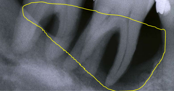 歯の根元が溶けていく図