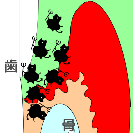 歯周病の歯の断面図